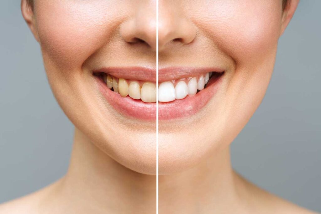 ¿Has pensado en mejorar tus dientes? ¡Cuenta con nuestra estética dental en Zaragoza! Diseño de Sonrisa, blanqueamientos y carillas hechas a medida.
