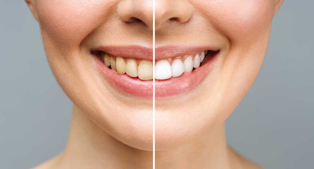 blanqueamiento dental en Zaragoza, blanqueamiento dental ambulatorio en Zaragoza, blanqueamiento dental en clínica en Zaragoza, blanqueamiento combinado en Zaragoza.