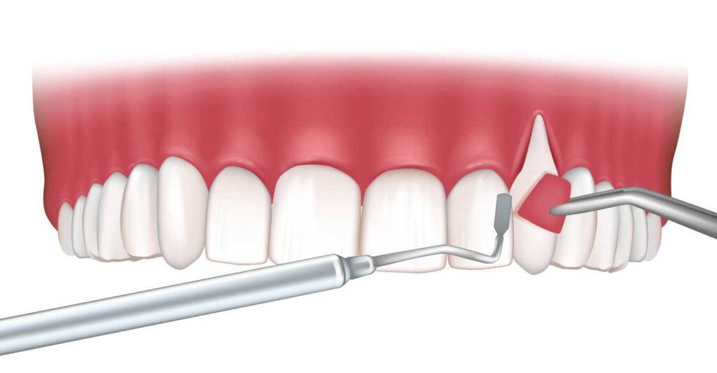 periodoncia en Zaragoza, tratamiento para las encías en Zaragoza, tratamiento para la enfermedad de las encías en Zaragoza.