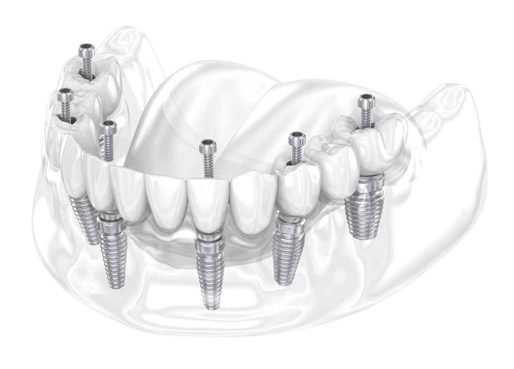 implantes dentales en Zaragoza, implantología oral en Zaragoza, implantología dental en Zaragoza, prótesis fija sobre implantes dentales en Zaragoza.