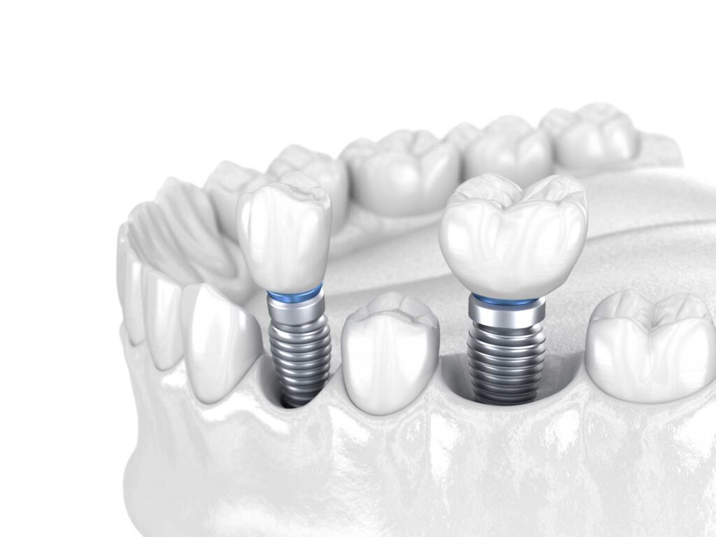 implantes dentales en Zaragoza, implantología oral en Zaragoza, implantología dental en Zaragoza, prótesis fija sobre implantes dentales en Zaragoza.