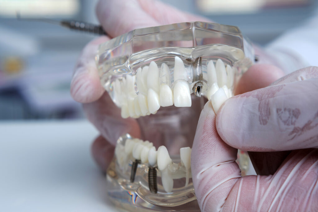 los implantes pueden provocar rechazo