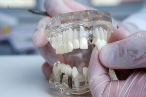 los implantes pueden provocar rechazo