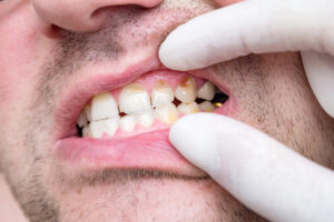Erosión ácida dental