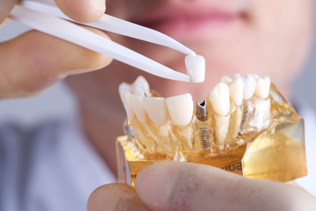 Errores antes y después de un implante dental